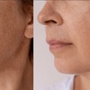 Image 1: Muscle Sculpting Skin Tightening Non-Surgical Facelift