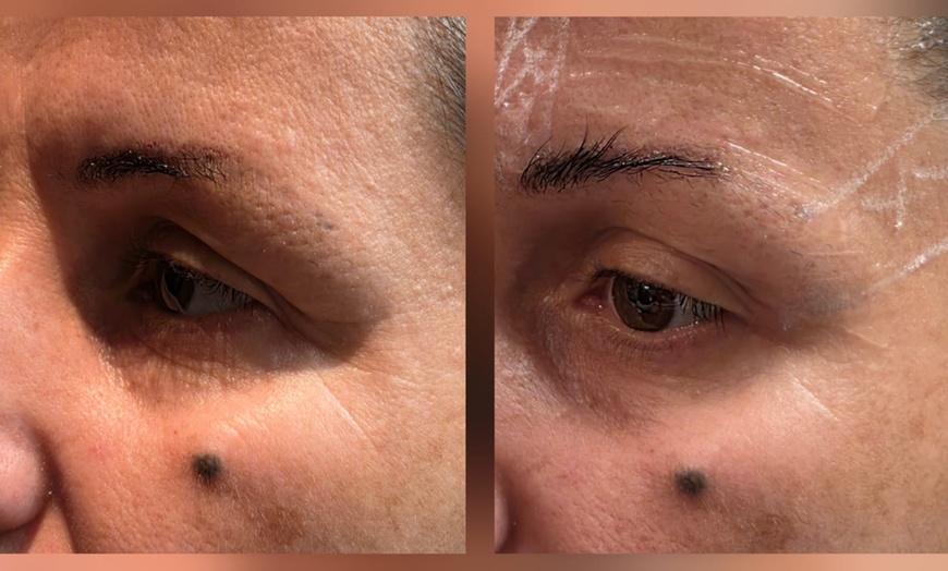 Image 4: Transform with HIFU Treatment on Neck, Half or Full Face or Body 