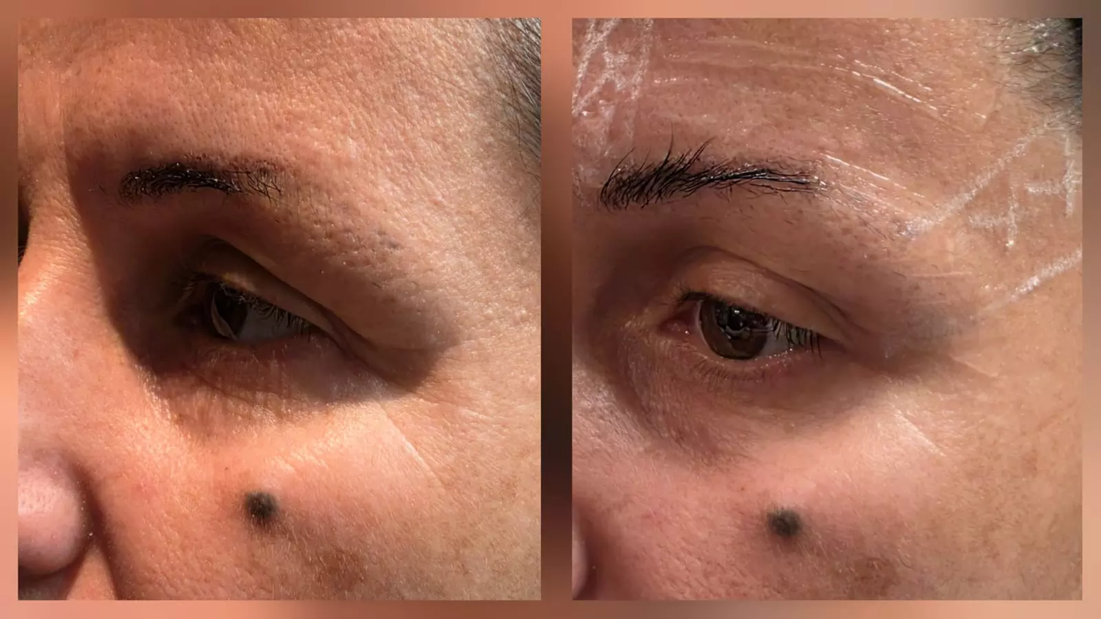 Transform with HIFU Treatment on Neck, Half or Full Face or Body