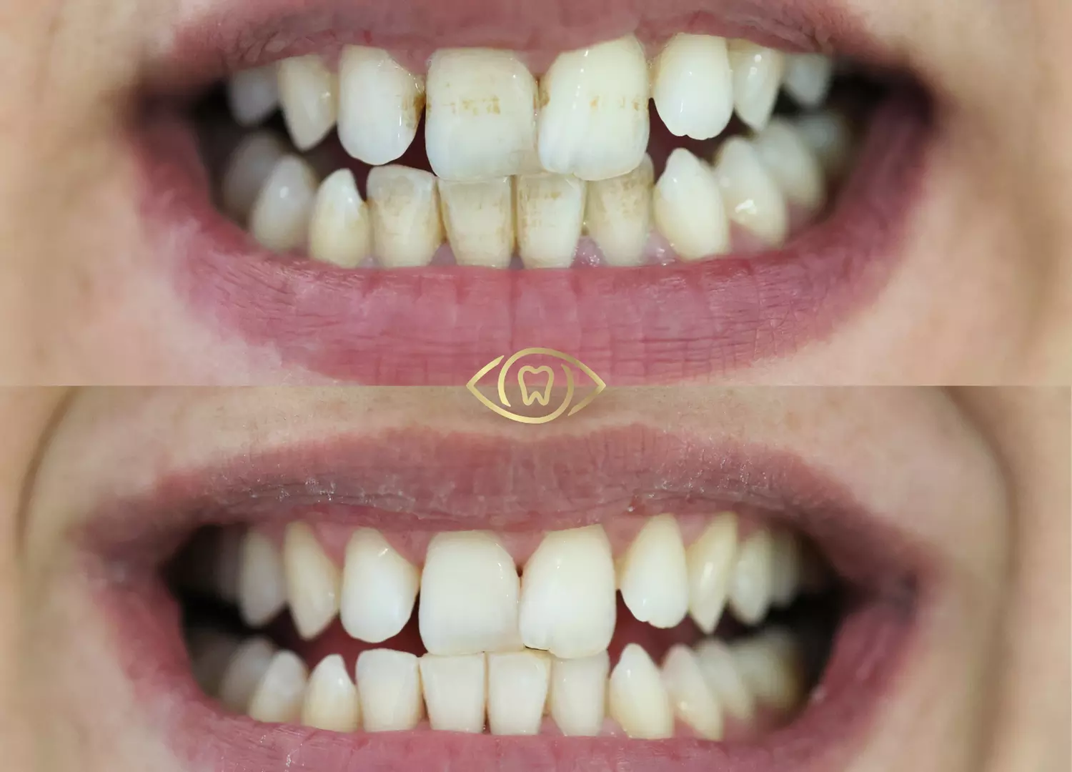 Up to 64% Off on Teeth Cleaning at Eye & Dental Clinic