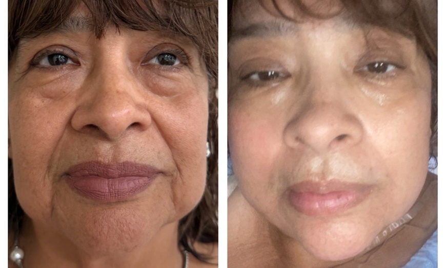 Image 8: Up to 55% Off on Laser Skin Resurfacing at Amora Med Spa