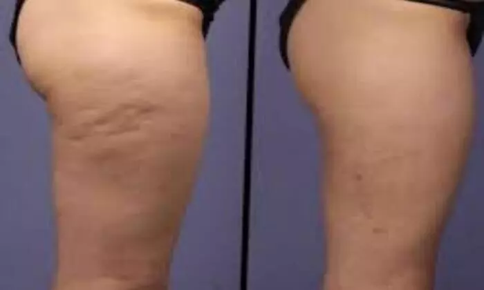 Up to 59% Off on Lipo - Non-Invasive Laser-iLipo at Karisma Esthetics - Second Medium