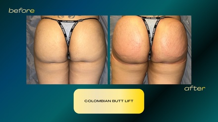 One Colombian Butt Lifts - Refusionate Wellness and Aesthetic