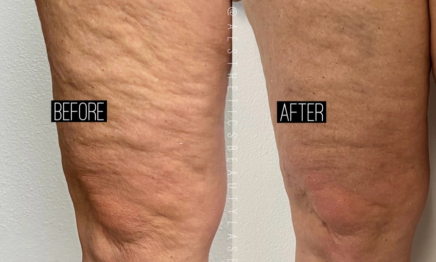 Image 5: Up to 84% Off on Lipo - Non-Invasive Laser-iLipo at Aesthetics Beauty Laser
