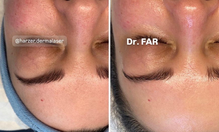 Image 3: Premium Glow-Facial inkl. Wickeltherapie & MatrixxFace für 1 Person