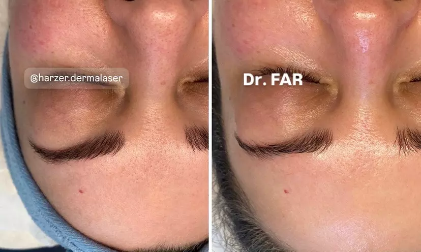 Premium Glow-Facial inkl. Wickeltherapie & MatrixxFace für 1 Person