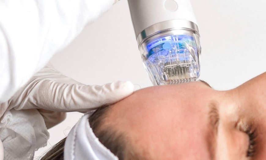 Image 3: Up to 64% Off on Micro-Needling at UK Aesthetics Lounge
