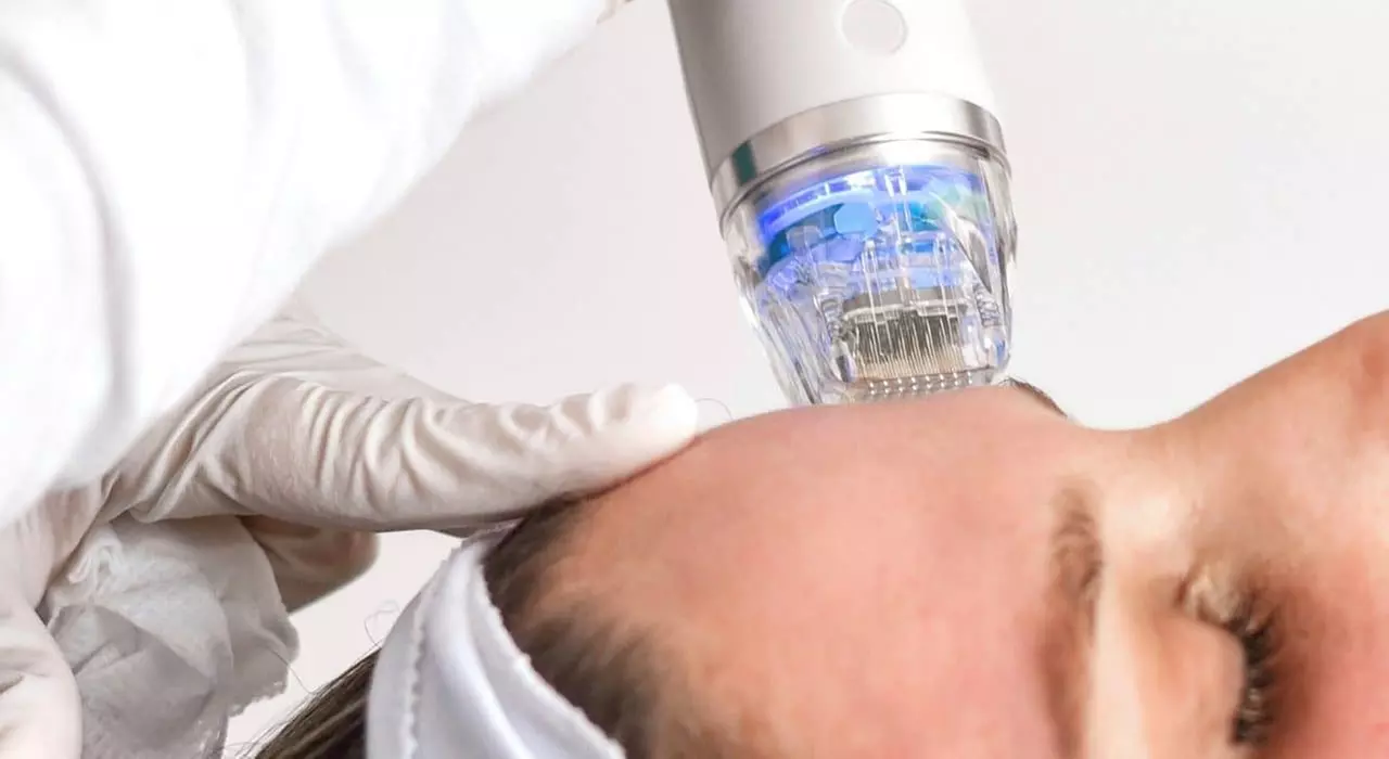 Up to 55% Off on Micro-Needling at UK Aesthetics Lounge