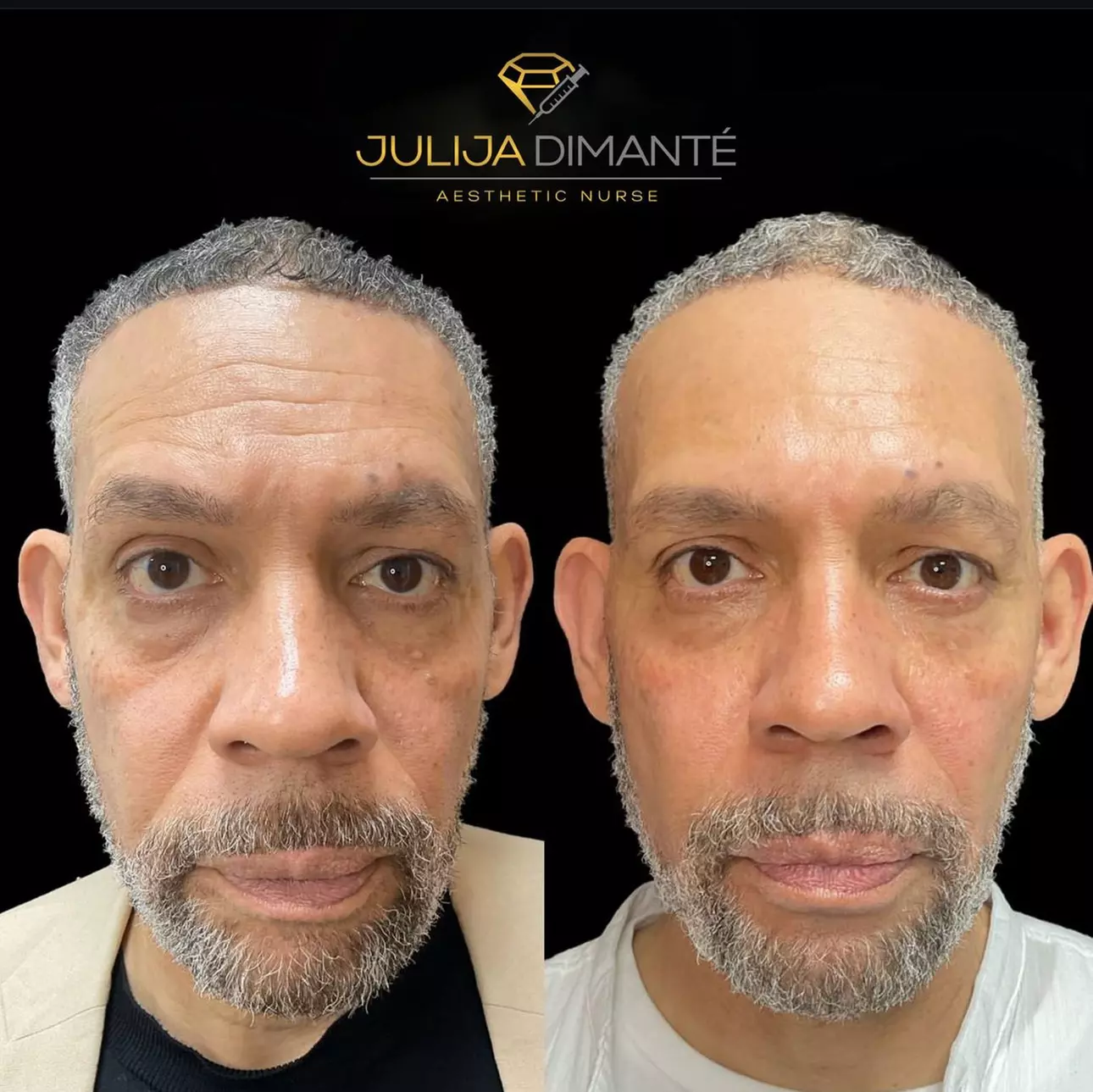 One Fraxel Laser Skin Resurfacing Treatment for Neck or Full Face