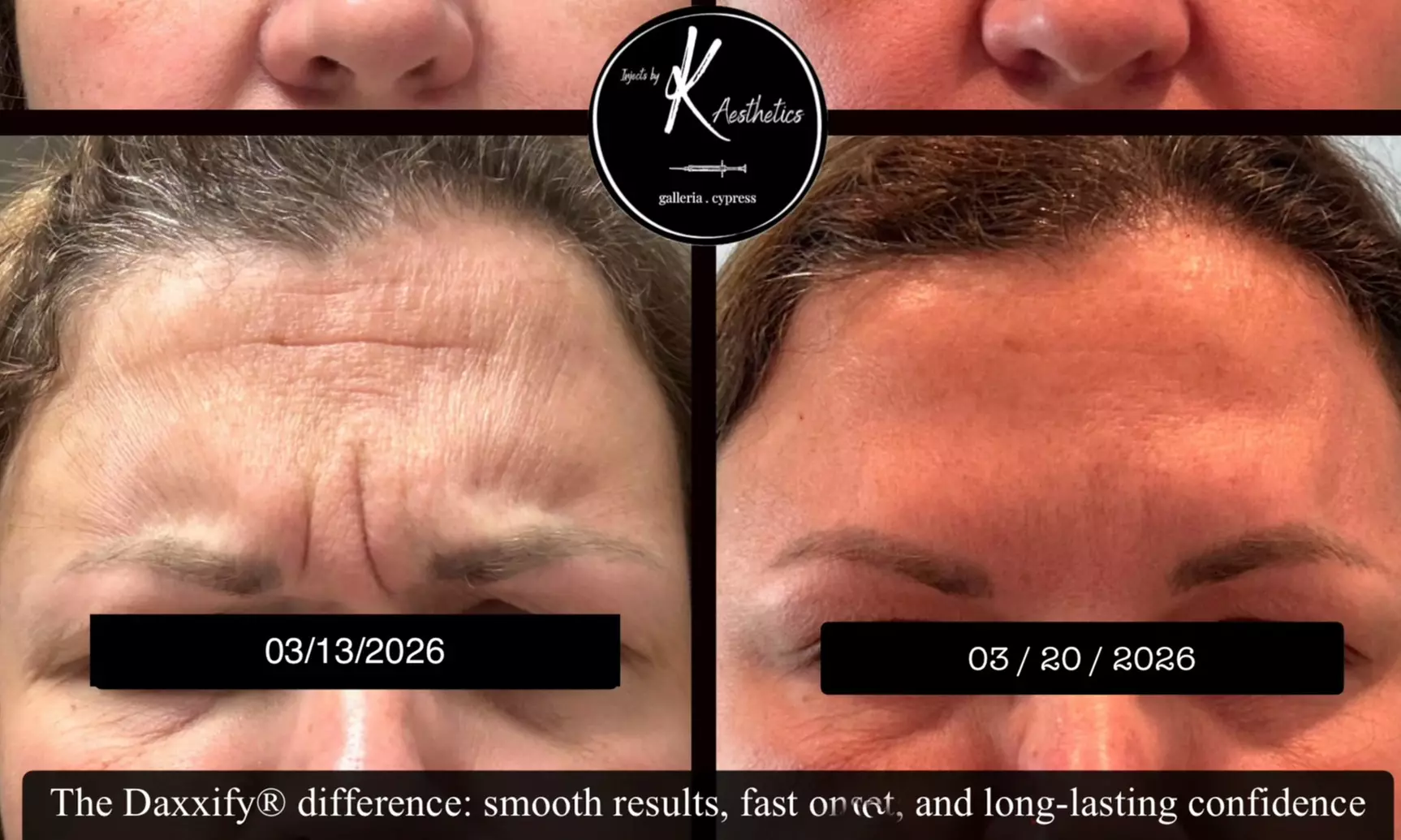 Long-lasting Daxxify Treatments for a Flawlessly Smooth Look at Injects by K