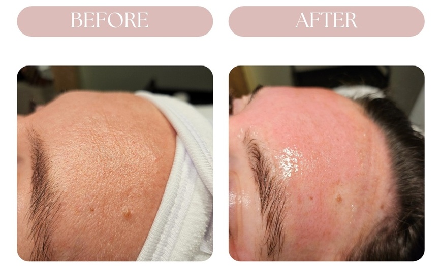 Image 4: Luxury Microneedling Facial or Microneedling Facial & Dermaplaning