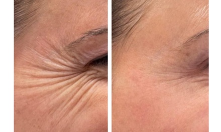 20 Units of Xeomin, Jeuveau or Daxxify - Forever Young by Rita