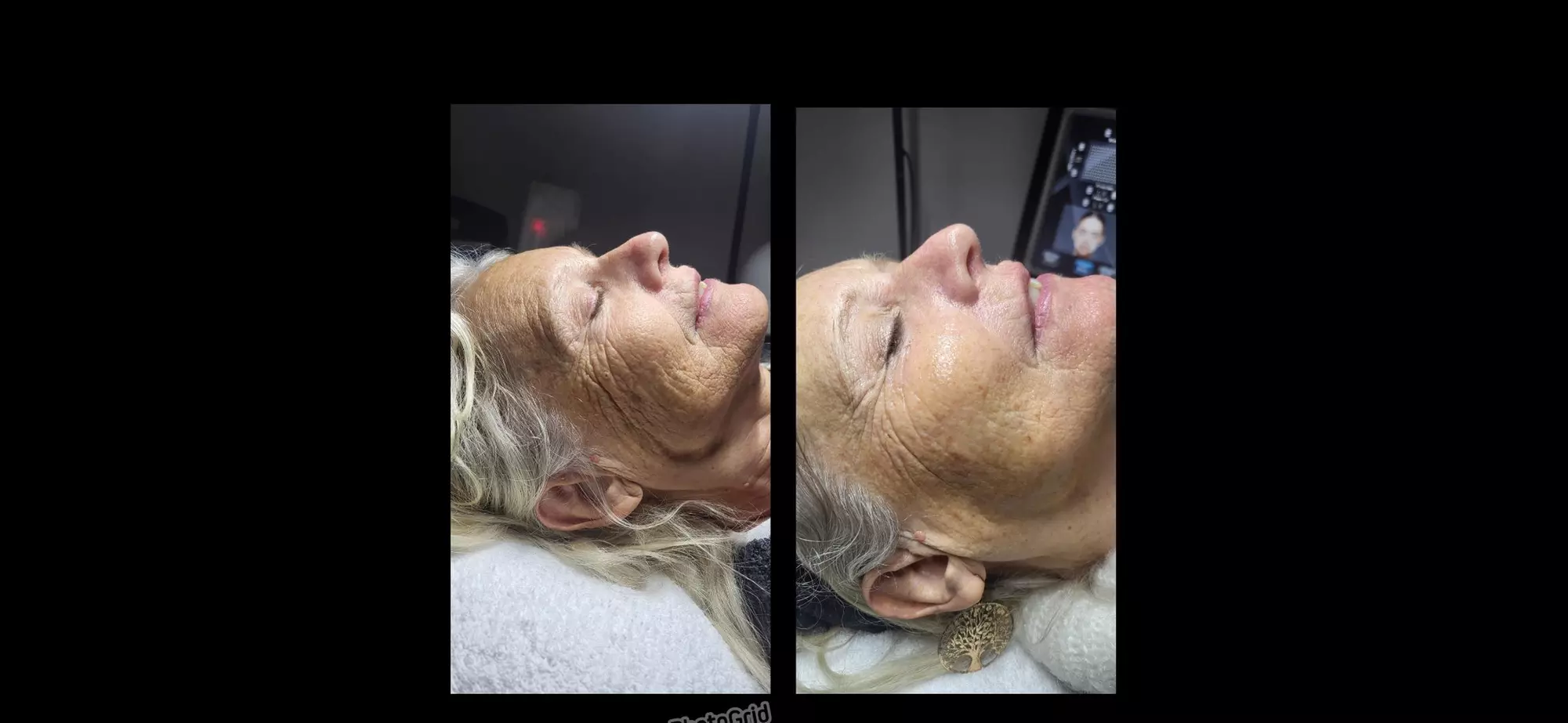 Soin du visage liftant coréen, Hydra ou Lumin’Lift chez Eternalift