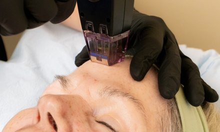 Morpheus face and neck with PRP and exosomes  - Apex Urology & Aesthetics