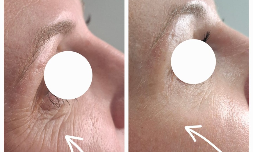 Image 7: Do 56% zniżki na Zastrzyk - Botox w Richter Clinic Iwona Richter