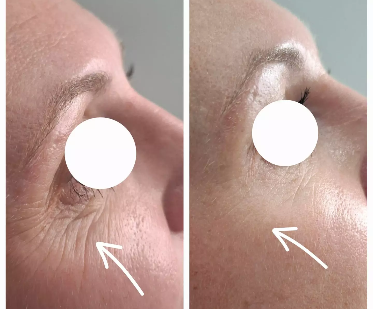 Do 56% zniżki na Zastrzyk - Botox w Richter Clinic Iwona Richter