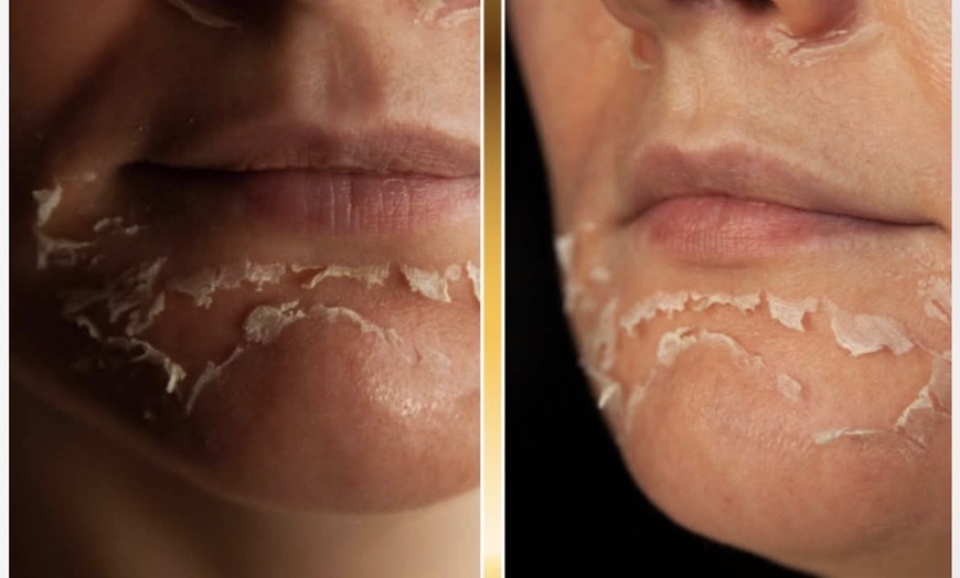 Image 3: Gift Card Toward 60-Min Service or TCA Cross for Skin Scars
