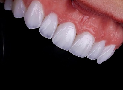 Dental Exam, x-rays and Cleaning - Pompano Family Smiles