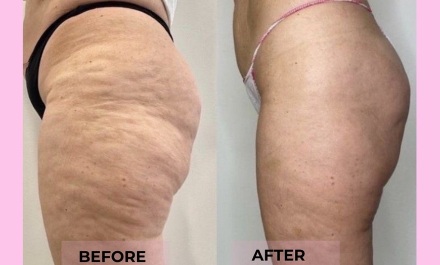 Image 1: Two or Three VelaShape III at Beauty Factory Boutique Spa 