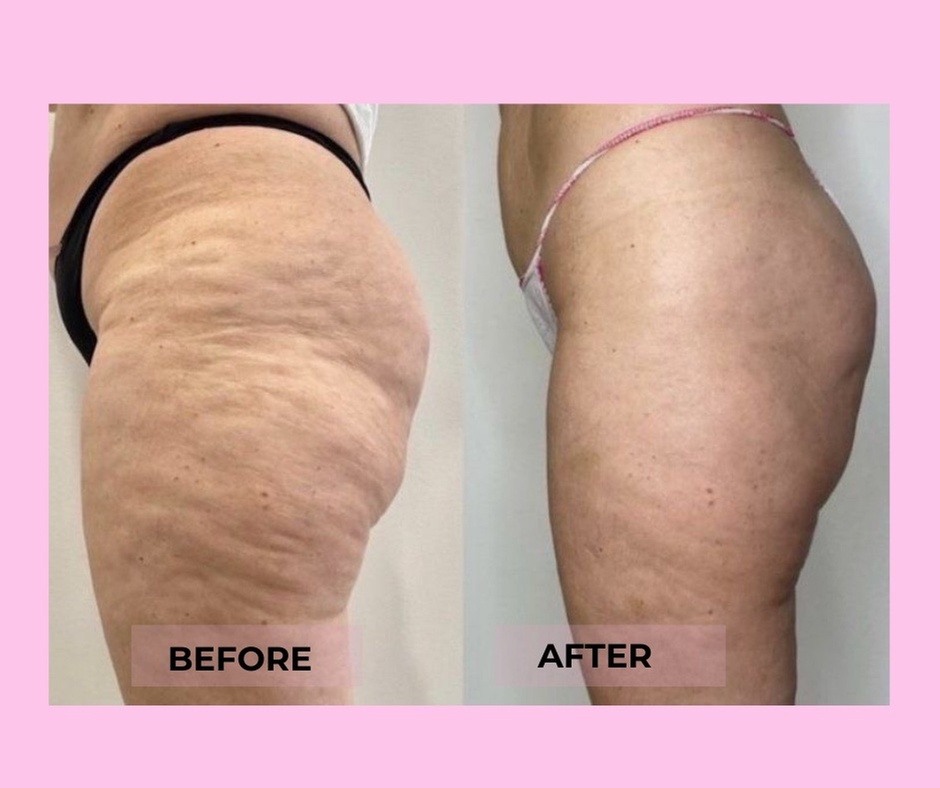 Two or Three VelaShape III at Beauty Factory Boutique Spa