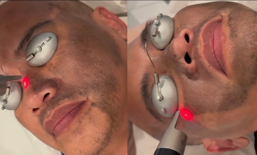 Image 1: Pico Laser Carbon Peel with Complimentary Facial Cleaning
