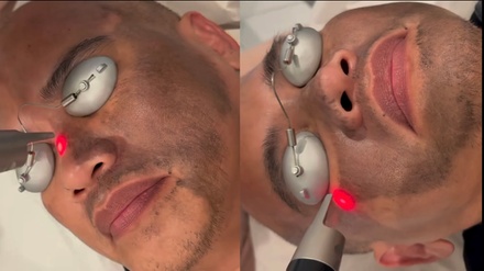 Carbon Laser Peel - bc clinic
