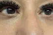 Up to 59% Off on Target Dark Circles & Puffiness: PRF Under-Eye Therapy (1/ 3 Sessions) at New life Cosmetic llc - Second Medium