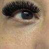 Image 2: Target Dark Circles & Puffiness: PRF Under-Eye Therapy (1/ 3 Sessions)