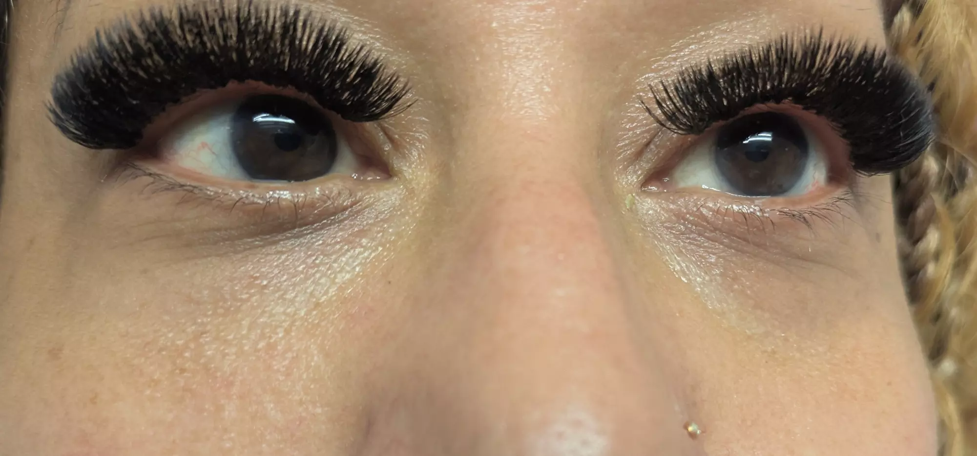 Target Dark Circles & Puffiness: PRF Under-Eye Therapy (1/ 3 Sessions)