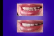 Achieve a Radiant Smile with Custom Professional Teeth Whitening Treatment at StarSmiles (Up to 33% Off) - Second Medium