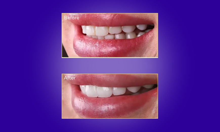 Image 4: Transform Your Smile with Custom Teeth Whitening