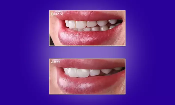 Transform Your Smile with Custom Teeth Whitening