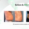 Image 2: Emerald Laser Fat Loss - Up To 4 inches Loss