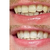 Image 4: Up to 30% Off on Teeth Whitening at Glow Beaute