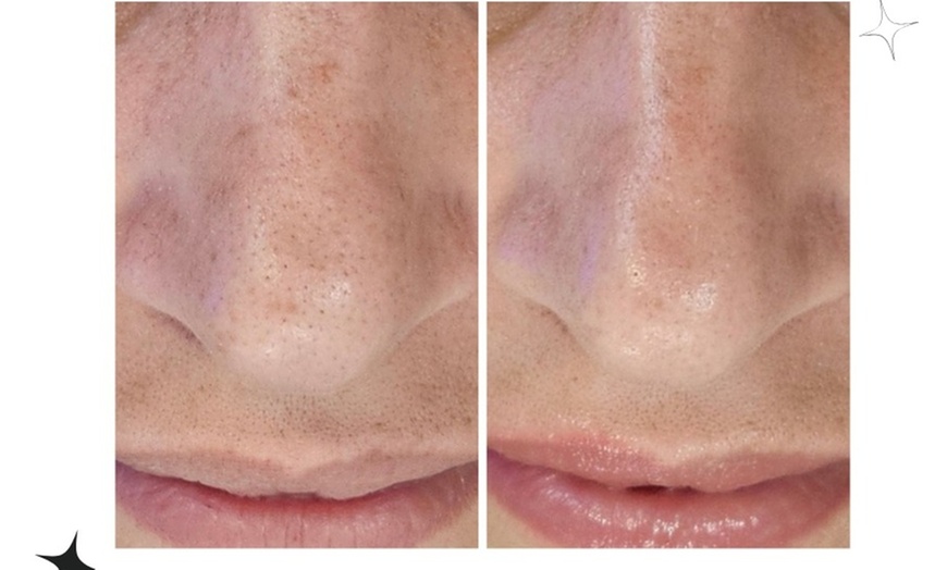 Image 9: Up to 31% Off on HydraFacial at Phoenix Esthetics of CT