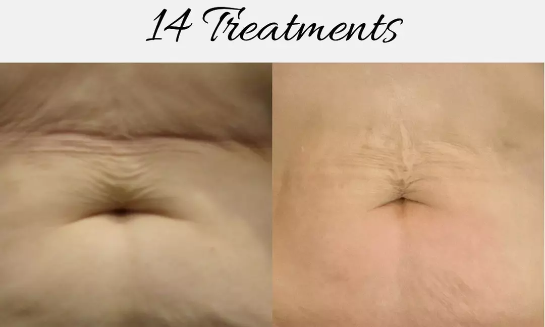 Up to 79% Off on Cavitation at Renew Contouring