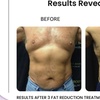 Image 5: Discover the Power of Venus Bliss:  Laser Lipolysis Treatments at Black Bella Dc Body Sculpting (Up to 40% Off)