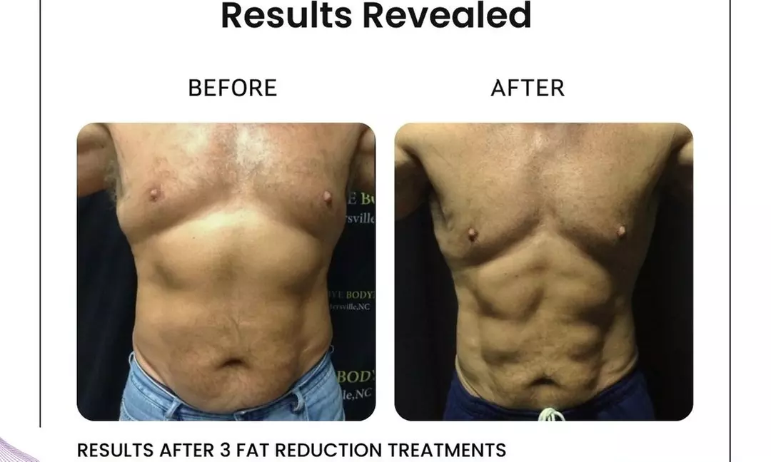 Discover the Power of Venus Bliss:  Laser Lipolysis Treatments at Black Bella Dc Body Sculpting (Up to 40% Off)