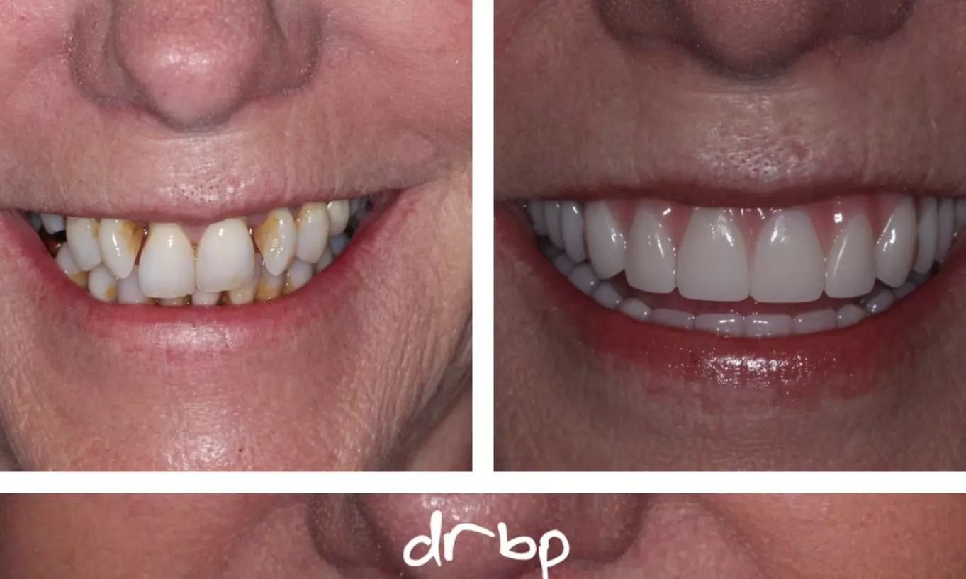 Up to 66% Off on Teeth Cleaning at Mesquite Dental Solutions - Second Medium