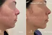 Up to 64% Off on Ultherapy / Ultrasonic Facial at One Beauty Aesthetics - Second Medium