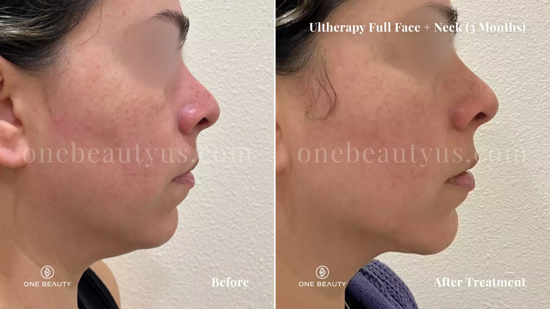 Ultherapy / Ultrasonic Facial at One Beauty Aesthetics