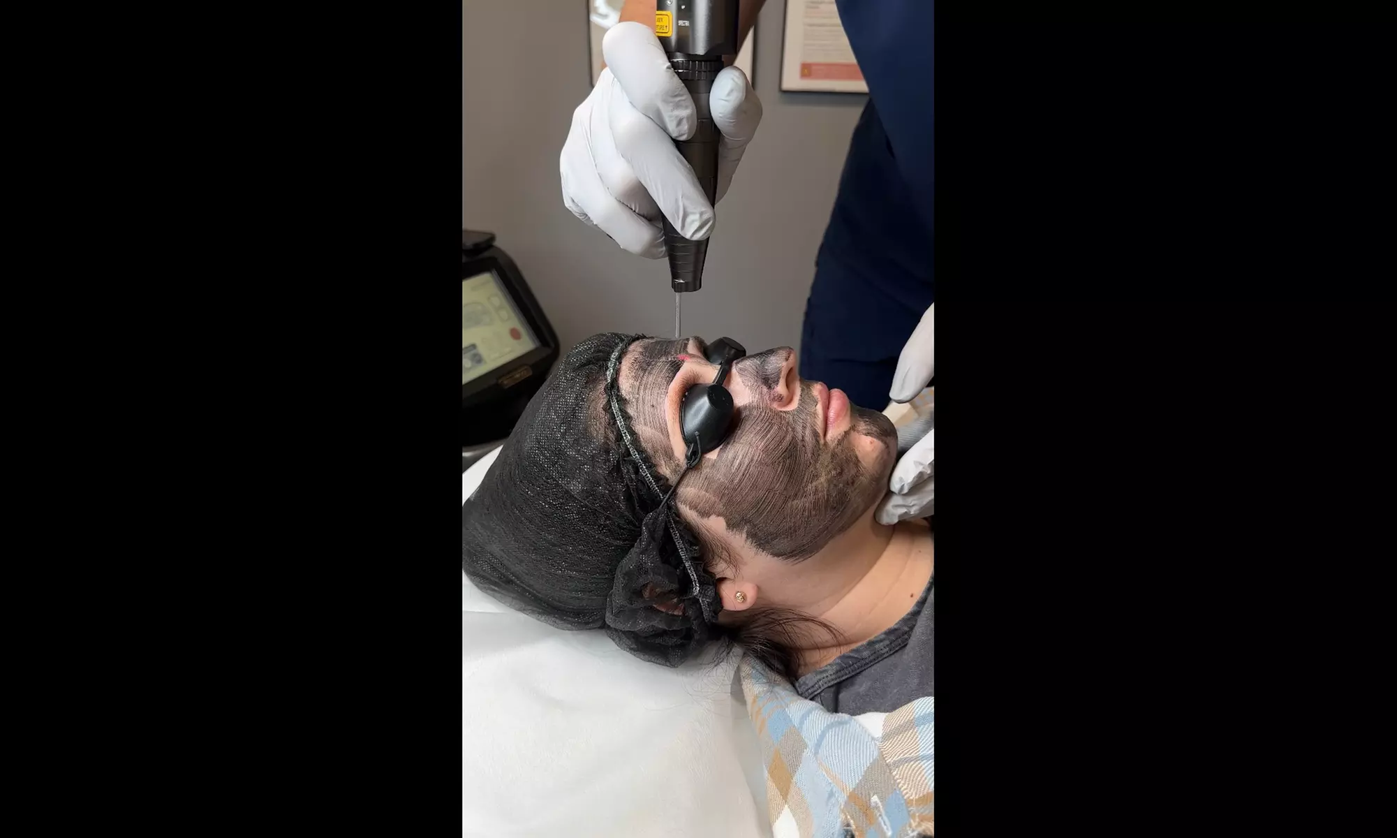 Glow Up with Carbon Laser Peel for Face & Neck