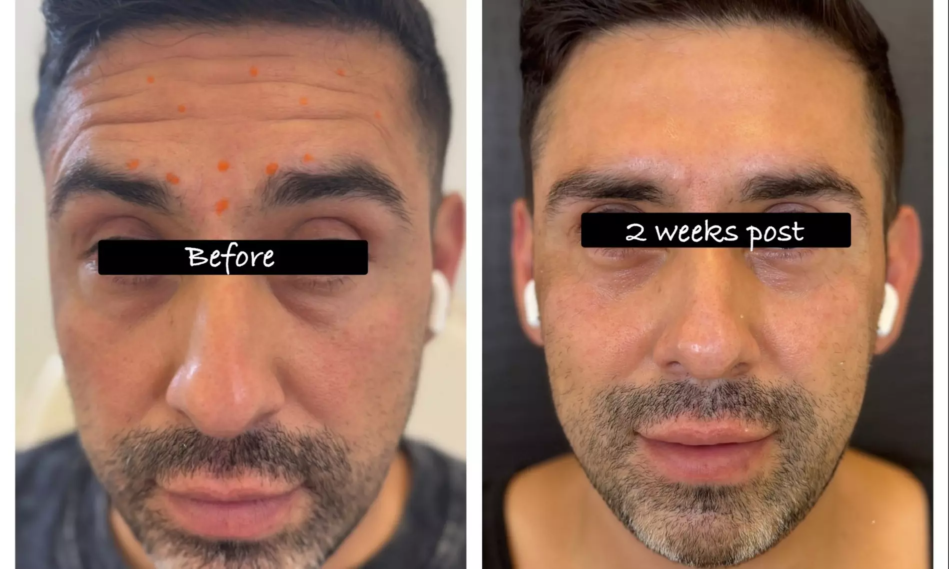 Long-Lasting Radiance: Premium Daxxify Smoothing Treatments