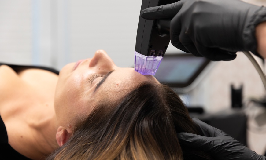 Image 2: Up to 60% Off on Advanced Microneedling & Radiofrequency