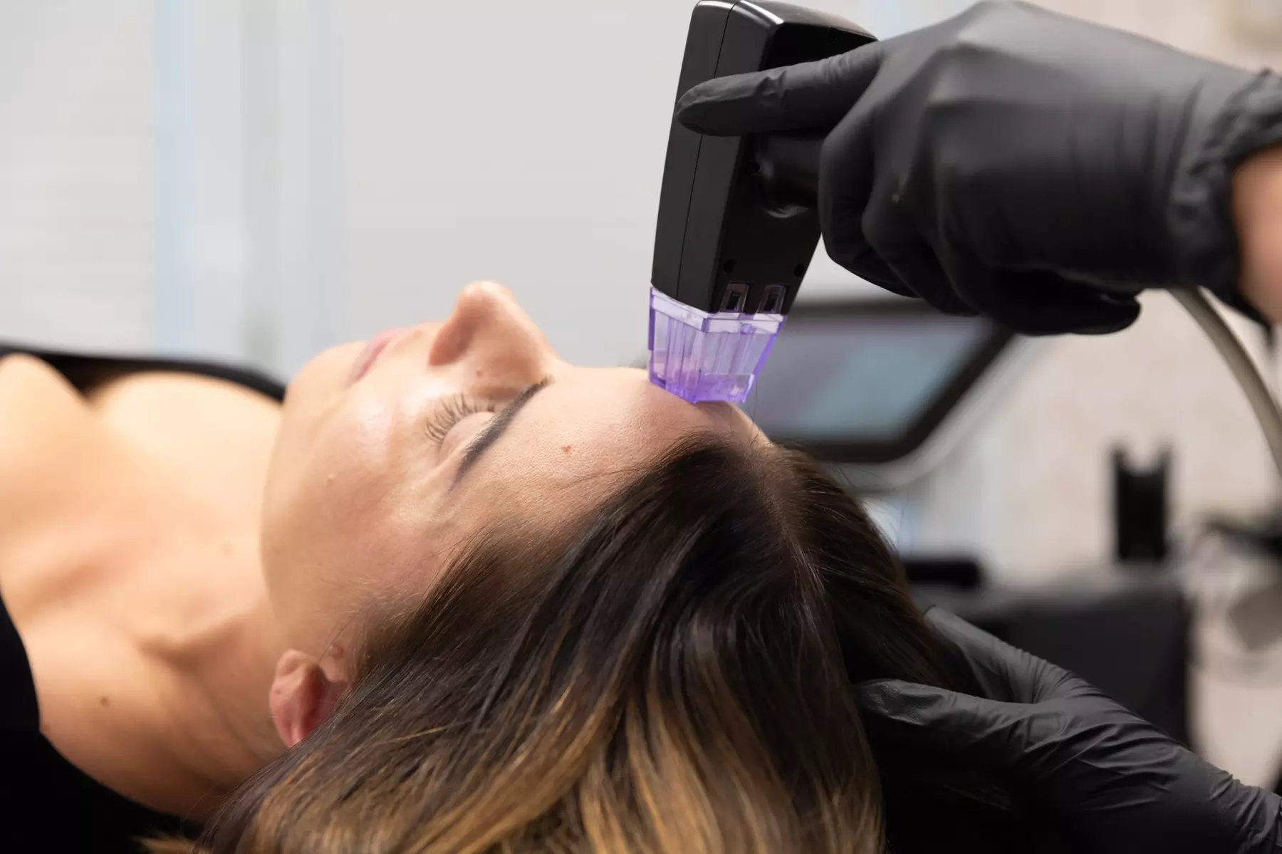 Up to 55% Off on Advanced Microneedling & Radiofrequency