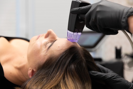 One Session Morpheus RF: Advanced Microneedling & Radiofrequency (One Area) - Time for You Medical Spa