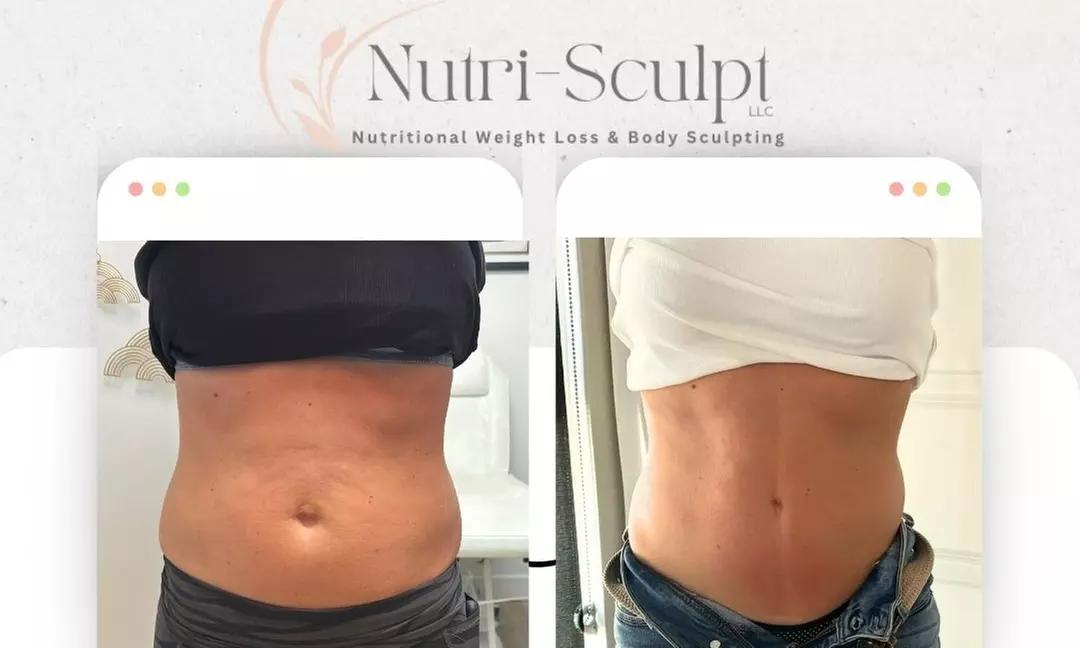 Up to 52% Off on Radio Frequency Skin Tightening at Nutri-Sculpt LLC - Primary Image
