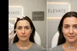 20, 40, or 60 Units of Botox Injections For Smooth Skin With Expert Care at Elevate and Save Up to 39% Off - Second Medium