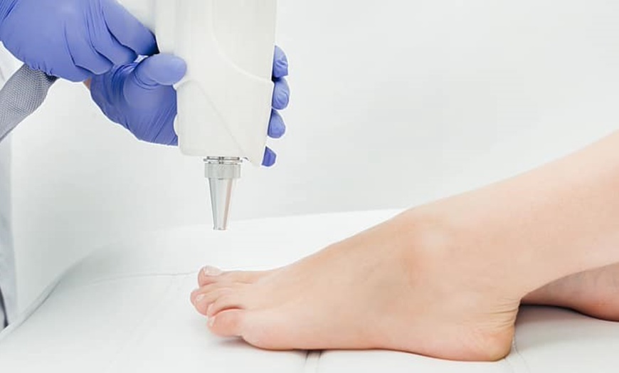 Image 1: Up to 70% Off on Laser Fungal Nail Removal at Haiir & Skiin