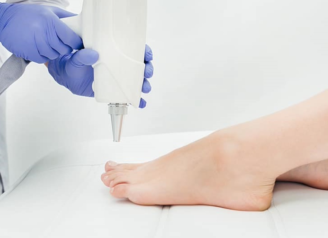 Up to 70% Off on Laser Fungal Nail Removal at Haiir & Skiin